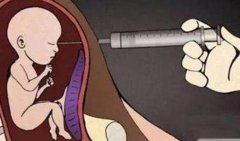 引产针的作用和注意事项：胎儿反应与恢复