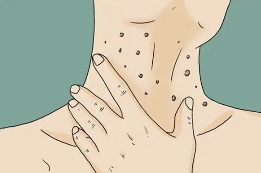 瘊子的最佳治疗方法解析