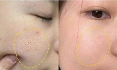 面部毛孔扩张的成因及解决方案