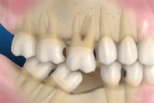 牙齿畸形解密：挑战不规则，拥抱自信微笑