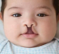 唇裂背后的治疗与希望：了解唇裂畸形及其关键治疗方向