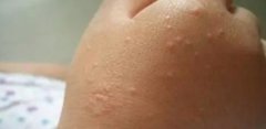 解密儿童急性皮炎的科学治疗