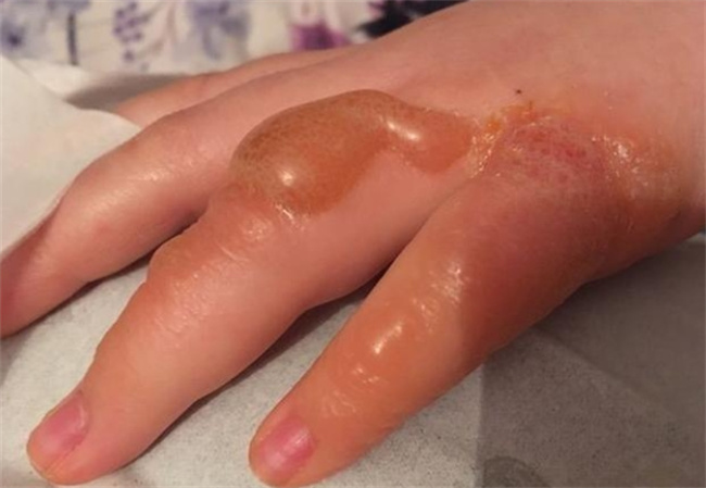 初生牛犊不怕虎：孩子烫伤应急五步曲