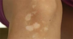 白癜风初现：洞察早期症状