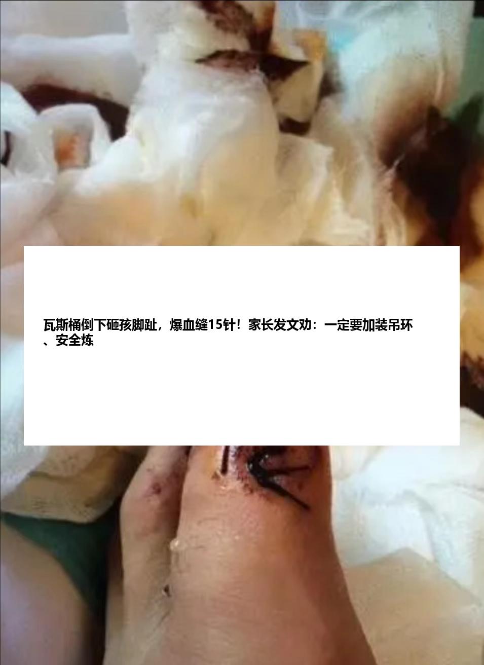 瓦斯桶倒下砸孩脚趾，爆血缝15针！家长发文劝：一定要加装吊环、安全炼