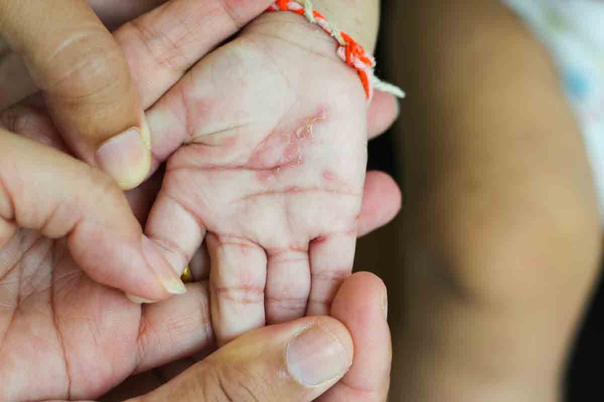 14种治疗儿童牛皮癣的方法可帮助婴儿不再发痒