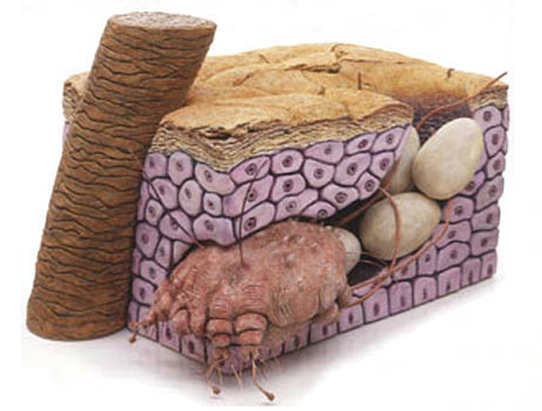 儿童疥疮如何有效治疗?