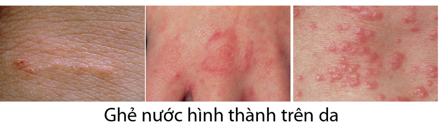 儿童疥疮如何有效治疗?