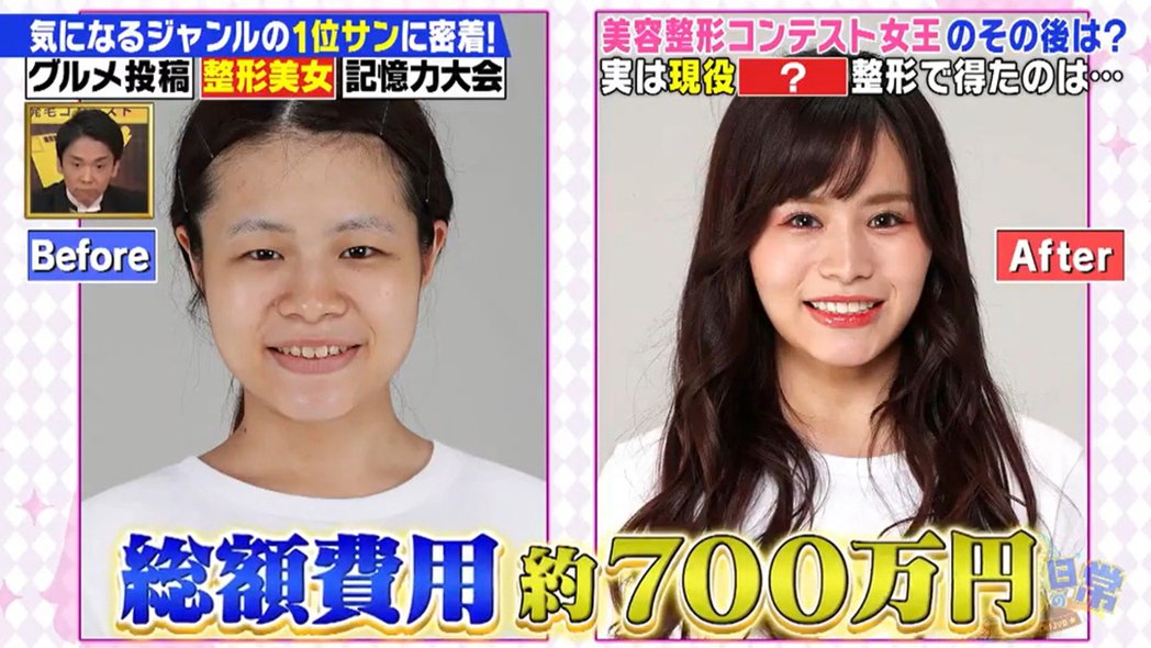 23岁女偶像「太丑没粉丝」　怒砸188万整形