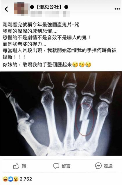 和老婆看「咒」手被捏断POＸ光片超惊人！