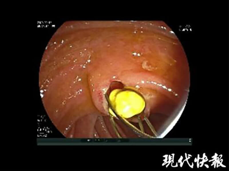 11岁女童不常吃早餐，腹痛检查竟是染上胆结石！医：按时吃早餐有助预防胆结