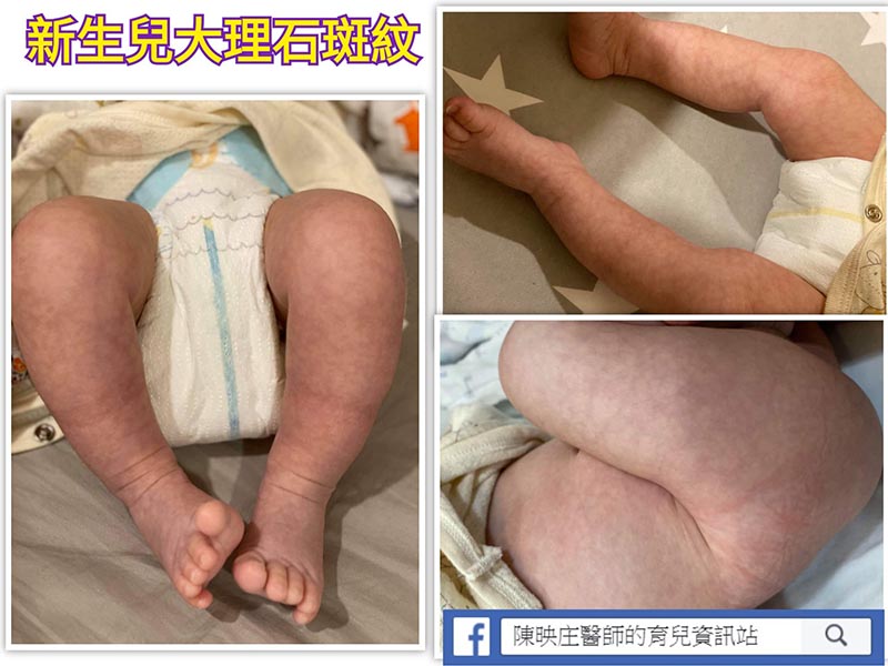 宝宝冬天皮肤面的「紫紫花花」父母好担心！儿科医师：免担心，不是生病！
