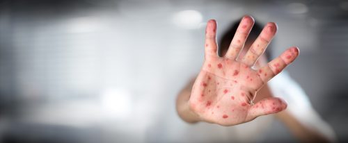 6岁男童肠病毒重症抽搐丧失意识，爸妈照顾也会感染，2症状就是中镖！