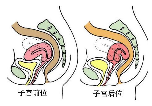 临床多发子宫后位，尽早发现防范于未然