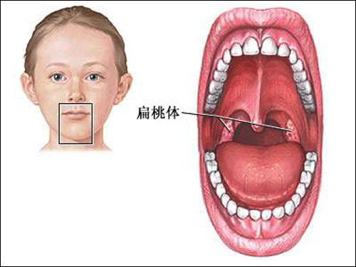 扁桃体发炎啦？别说没告诉你这些方法