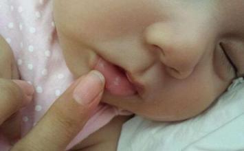婴幼儿常见病:宝宝鹅口疮如何预防和治疗