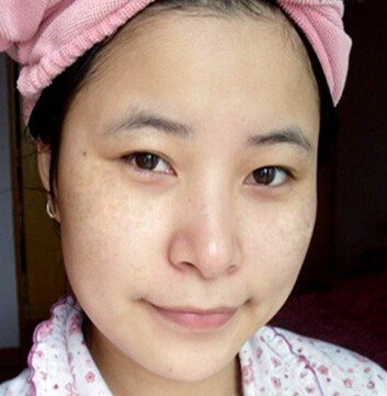 为什么产后容易长斑?吃什么可以淡化色斑?