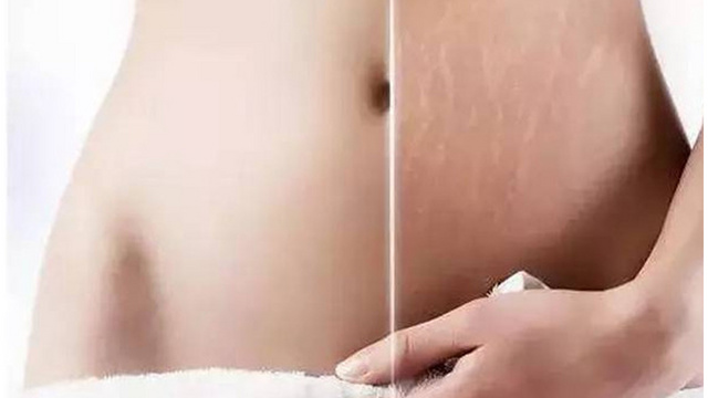 产后妊娠纹怎么消除?只需这6招!