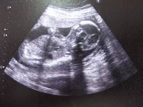 孕期B超、三维彩超、四维彩超  准妈们怀孕期间不同超声检查要会区分