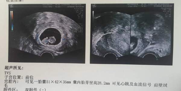 三维通过，确定是女宝，总结下怀孕后的症状！