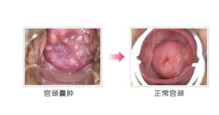 宫颈囊肿会自己消失吗 宫颈囊肿可以自愈吗