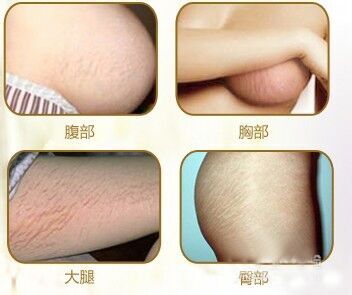 胸部妊娠纹怎么消除 怀孕胸部长妊娠纹怎么消除