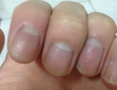 灰指甲的前期征兆 出现了这七种症状一定要警惕