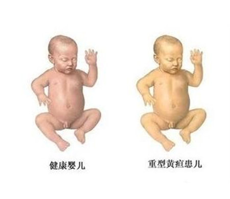 黄疸指数17用照蓝光吗 不照行吗 黄疸指数17用照蓝光吗 不照行吗