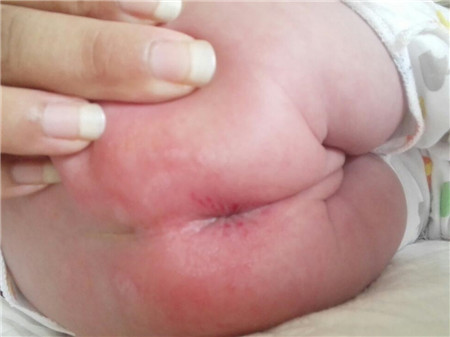 宝宝反复红屁股怎么办7 宝宝反复红屁股怎么办,知道这6点轻松搞定红屁屁