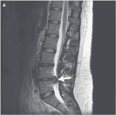 腰椎间盘突出能治好吗?