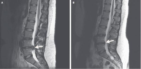 腰椎间盘突出能治好吗?