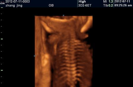 你的四维彩超真的很凶险！排畸后会致畸？