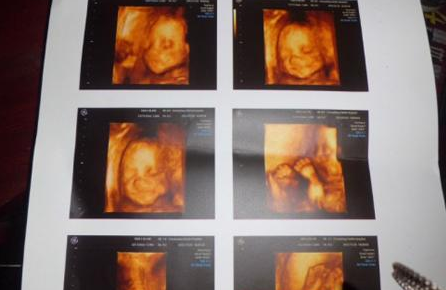 你的四维彩超真的很凶险！排畸后会致畸？