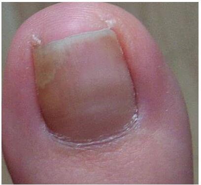 怎样才算是灰指甲？看看你有没有灰指甲