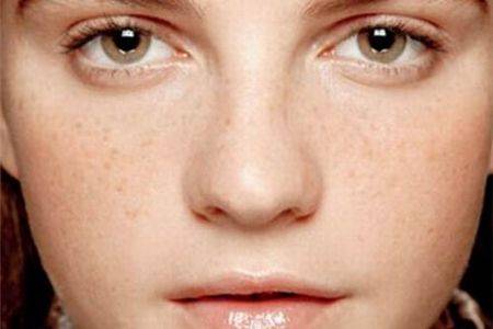 如何祛除脸上的雀斑 教你几个小方法