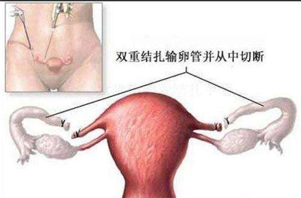 结扎对女性的影响大吗?女性结扎手术后要注意什么?