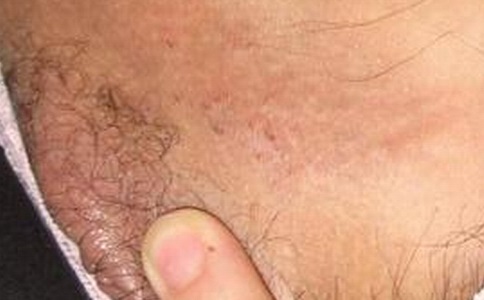 女性外阴湿疹的症状及图片