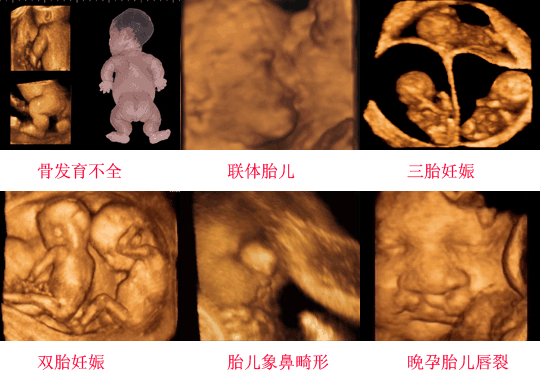 孕妈为什么一定要做四维彩超？否则后果会让你追悔莫及
