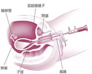 宫腔镜遭遇宫外孕怎么办