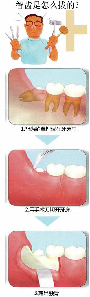 智齿一定要拔吗：这种情况智齿一定要拔掉（附拔智齿图）