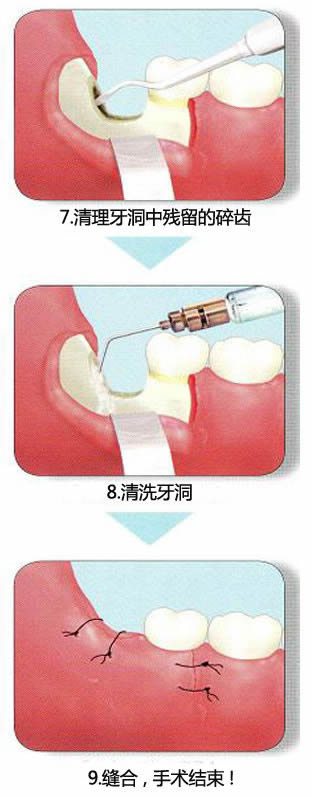 智齿一定要拔吗：这种情况智齿一定要拔掉（附拔智齿图）