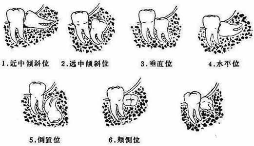 智齿一定要拔吗：这种情况智齿一定要拔掉（附拔智齿图）
