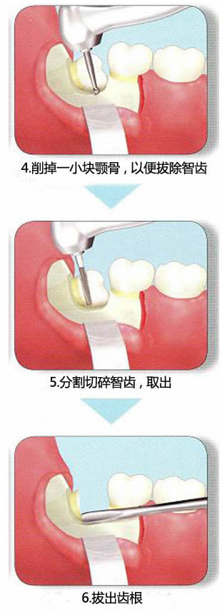 智齿一定要拔吗：这种情况智齿一定要拔掉（附拔智齿图）