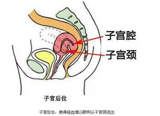 子宫后位会影响怀孕吗?关于宫后位你不知道的事