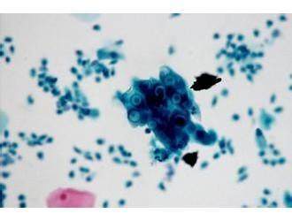 支原体感染到底多可怕,支原体感染和怀孕关系大吗?