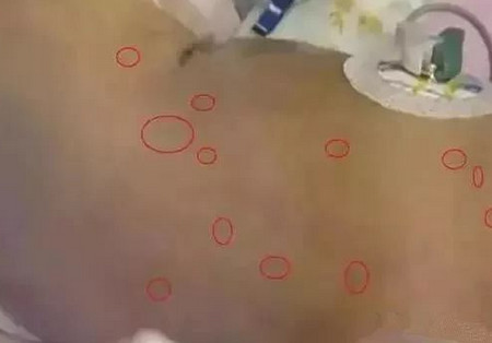宝宝生理性黄疸怎么降