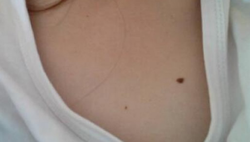 乳房上的痣图解代表什么：胸前有痣的命相分析