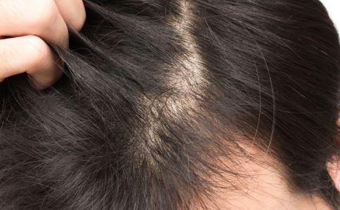 12岁女孩已开始脱发 防脱发究竟要怎么做