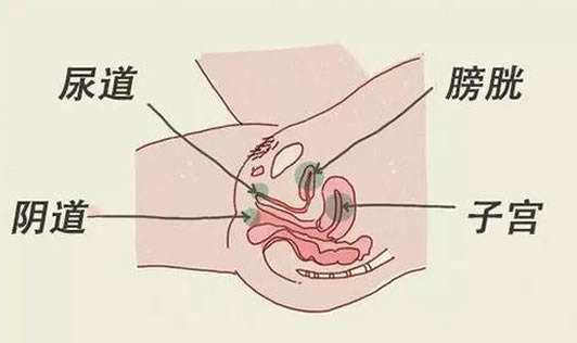 女性尿路感染是怎么引起的：女性尿路感染怎么办