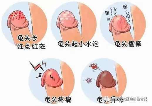 龟头上有红点是怎么回事：龟头有红点又痒是个什么梗